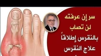 افضل ٣ وصفات منزلية بسيطة للتخلص من مرض النقرس