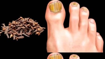 علاج فطريات القدم خلال ساعة